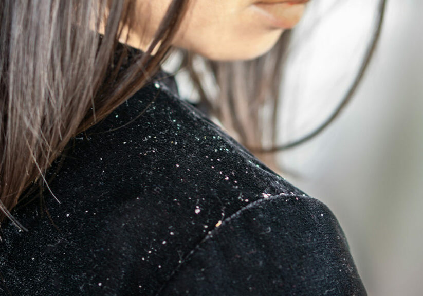 Dandruff, Dry Scalp, and Psoriasis: Similarities, Differences, and Treatments
