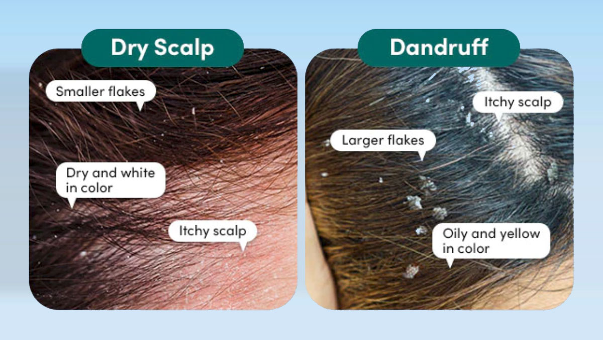 dandruff vs dry scalp